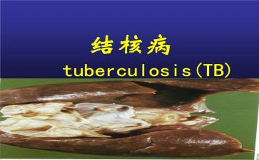 结核病工作计划5篇